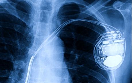 implanatable heart resynchronisers